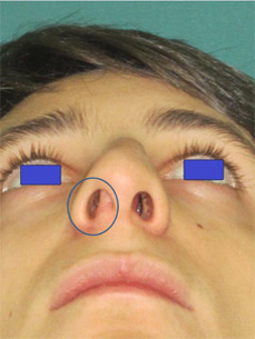 Turbinati nasali gonfi sintomi