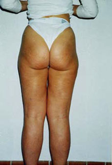 Liposcultura