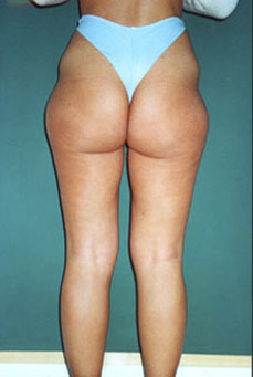 Liposcultura