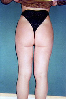 Liposcultura