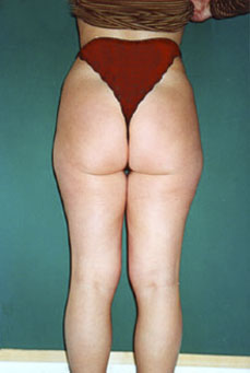 Liposcultura