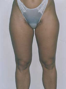 Liposcultura