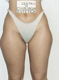 Liposcultura