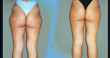 Liposcultura